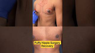 Puffy Nipple Surgery Recovery | What to Expect After Stitch Removal! | Dr DC, Plastic Surgeon