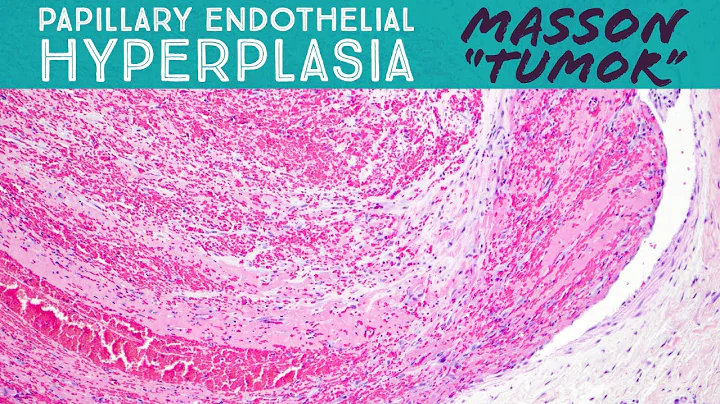 Masson "Tumor" (organizing thrombus & papillary endothelial hyperplasia in a vascular malformation) - DayDayNews