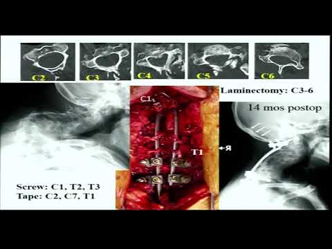 Talk on Correction of Craniocervical& cervical deformities in Sagittal and coronal planes