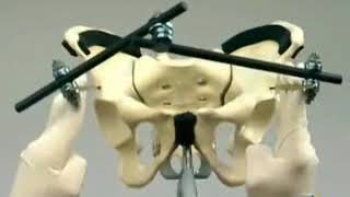 ExFix Pelvic ( АО видео на русском языке)