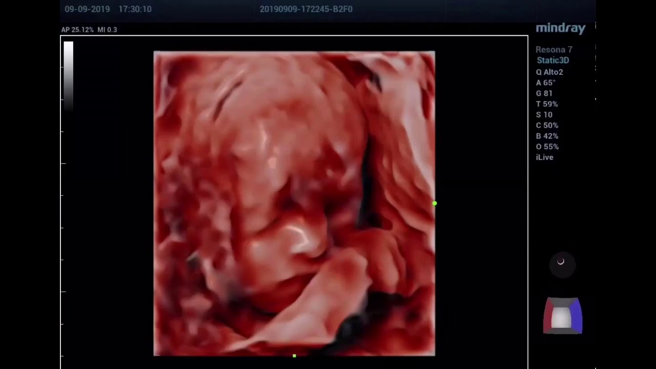 Ecografias De 24 Semanas De Embarazo ECOGRAFIA EN 6D 24 SEMANAS DE GESTACIÓN - YouTube