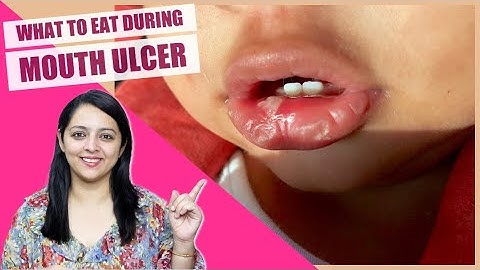 Best Soothing Foods during Mouth Ulcer in Kids | मुंह में छाले होने पे बच्चों को क्या खिलाएं