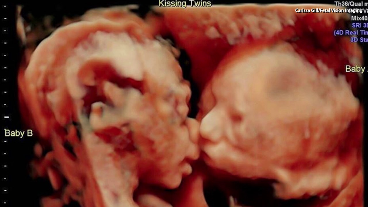 Ultrasound Captures Sweet Moment Between Twins in the Womb ...