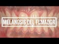 Pigmentación MELÁNICA Oral, MELANOSIS del fumador, pigmentación racial...