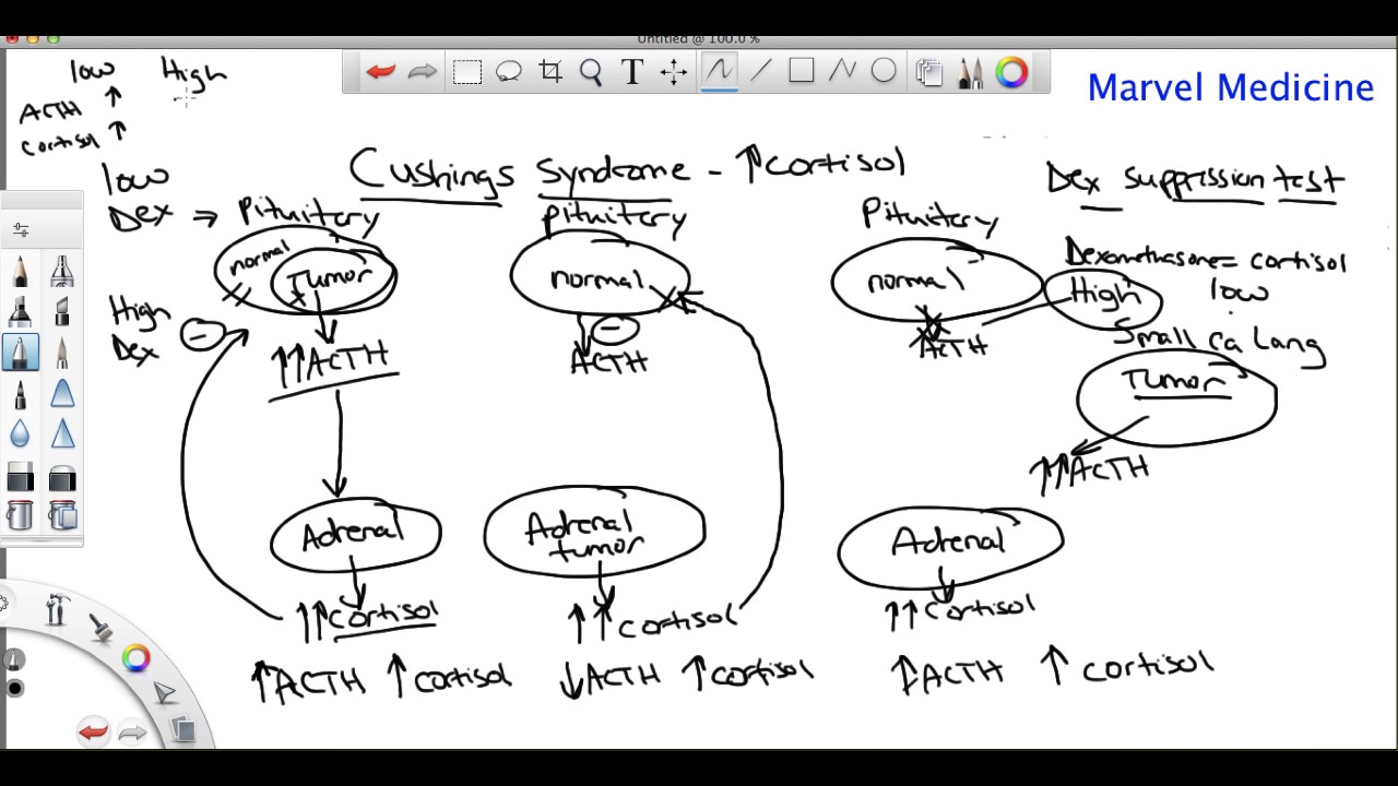 Cushings syndrome and the dexamethasone suppression test youtube