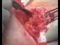 Limberg Flap Procedure for Pilonidal Sinus - www.kentsurgeon.com