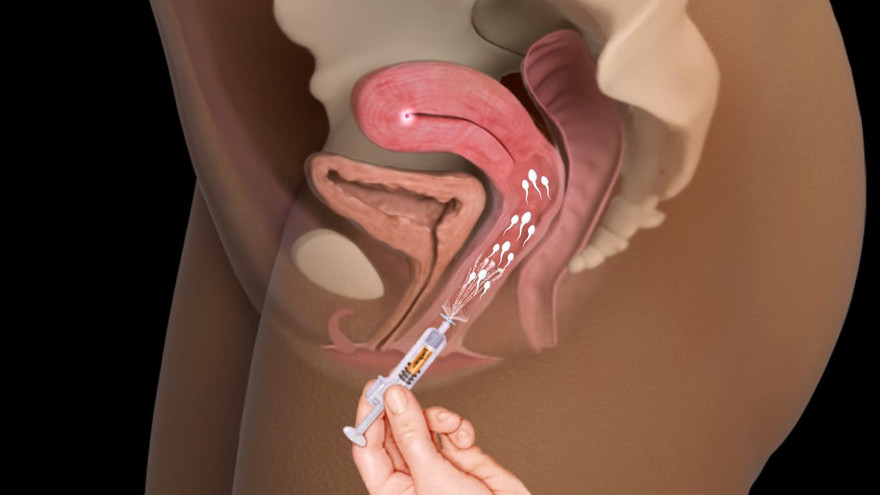حقن السائل المنوي داخل مهبل الزوجة(اسرع طريقة لحدوث الحمل)_ Intrauterine Insemination IUI procedure