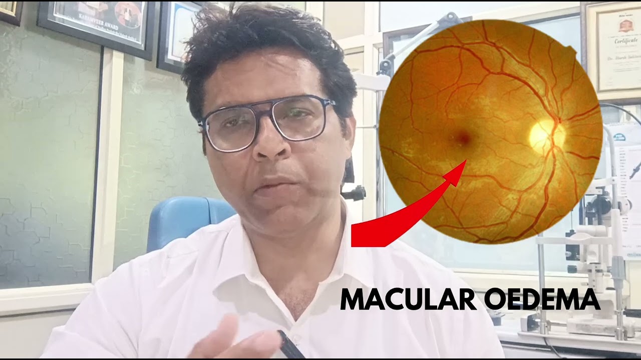 DIABETIC RETINOPATHY…. a threat to eye sight