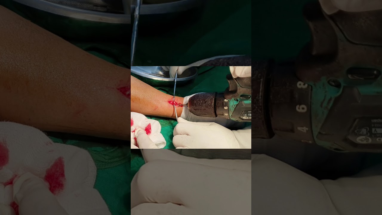 Fracture both bones forearm, per-cutaneous elastic nailing, adamya hospital videos