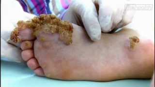 Embarrassing Bodies | Extreme Case of Warts