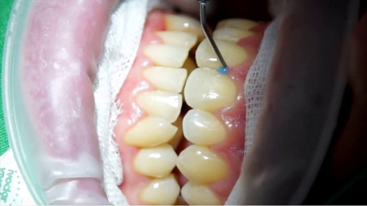 Use Asafetida To Treat Dental Problems What To Do YouTube