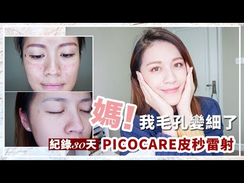 我去打皮秒了 毛孔真的有縮小 皮秒雷射30天實紀錄 心得 Youtube