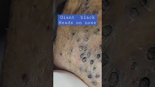 Giant black heads on nose | #shorts