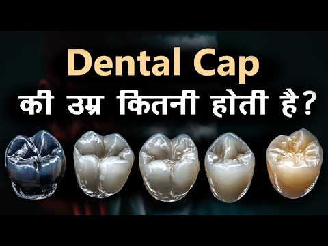 😱 Dental Cap की उम्र कितनी होती है? 🦷 पूरी जानकारी!🦷 How Long Does a Dental Cap Last?