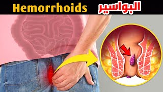 ازاي تعرف ان عندك بواسير؟! _ How do you know you have hemorrhoids?