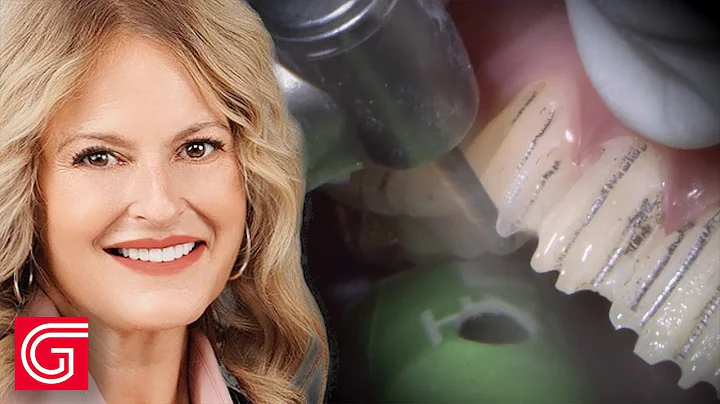 Hollywood Smile ANTERIOR Teeth Makeover?