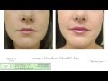 Lip enhancement options at skin by lovely