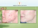 Cosmetic Lasers - Eliminate Cystic Acne and Scarring
