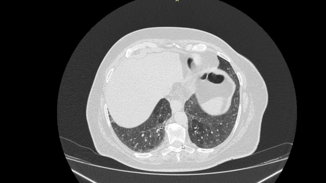 Слухати легені и дивитись КТ. - YouTube