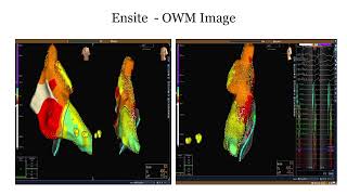 3D MAPPING OF RECURRENT PALPITAION -WPW SYNDROM