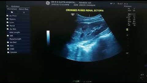 Crossed fused renal ectopia...  Both kidneys fused in left side.. Diagnosed by Dr aditya gupta....