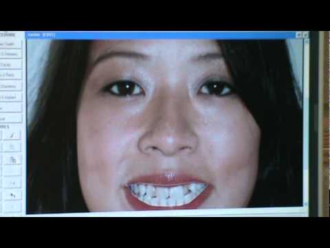 How do braces work?- Jenison MI Orthodontist