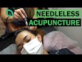 Advantages of needleless acupuncture for treating hair loss