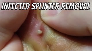 Big Puss Infected Splinter - Infection - Surgery - Emergency