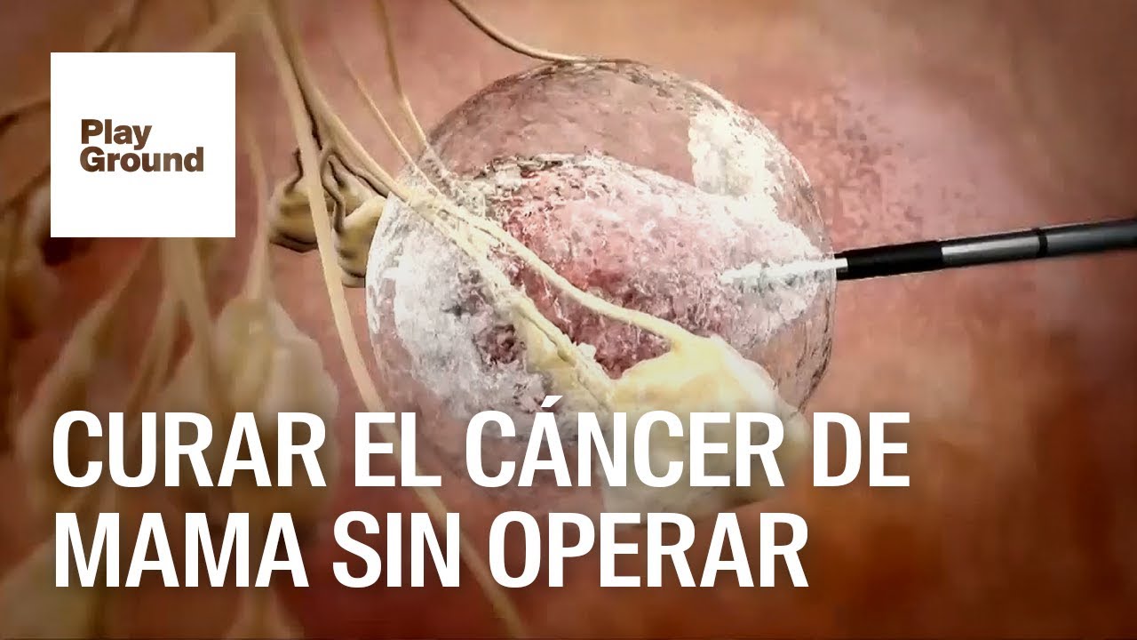 Cancer De Mama Descubren Como Curarlo Sin Cirugia Youtube