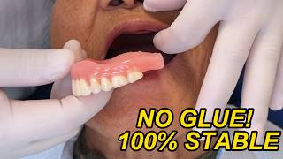 BEYOND TRADITION!🤫 Building a Full Denture from Scratch✨🦷#SuctionDenture #FullDenture