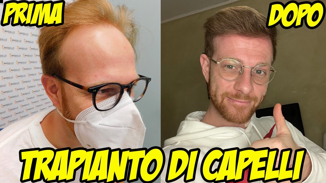 TRAPIANTO DI CAPELLI - RISULTATI DOPO 1 ANNO