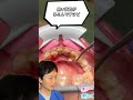歯石🦷取ったらハグキ👄が真っ黒❕❕❕歯医者👨‍⚕が解説📖します
