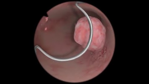 Polypectomy / Polyp Removal - Virtual Reality Simulation for Endoscopic Surgery