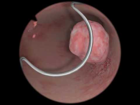 Video: Er en polyp en tumor?