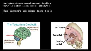 Brain meningioma and lymphoma || MRI