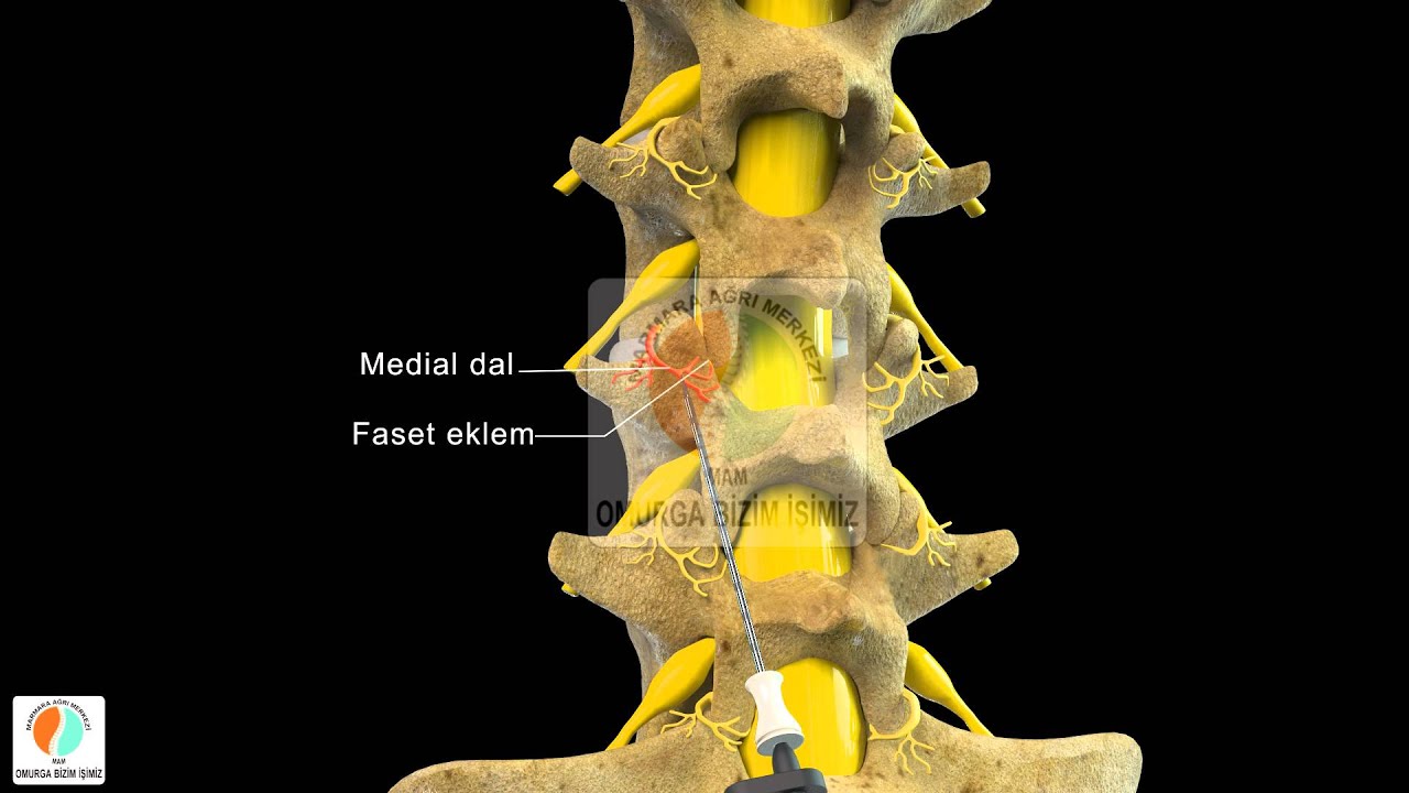 Faset Eklem Denervasyonu (Bel Kireçlenmesi) - Marmara Ağrı Merkezi