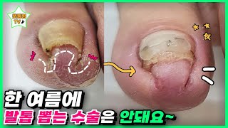 (eng sub)여름에 발톱 뽑는 수술은 안돼요~｜레푸스 서면점/사상점｜ingrown toenail｜Athlete&#39;s foot-Fresh Foot