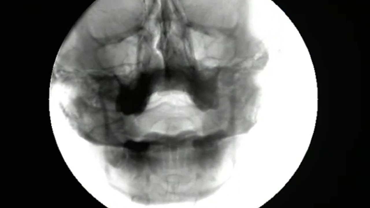 Digital Motion X-Ray showing Atlas/Axis Instability