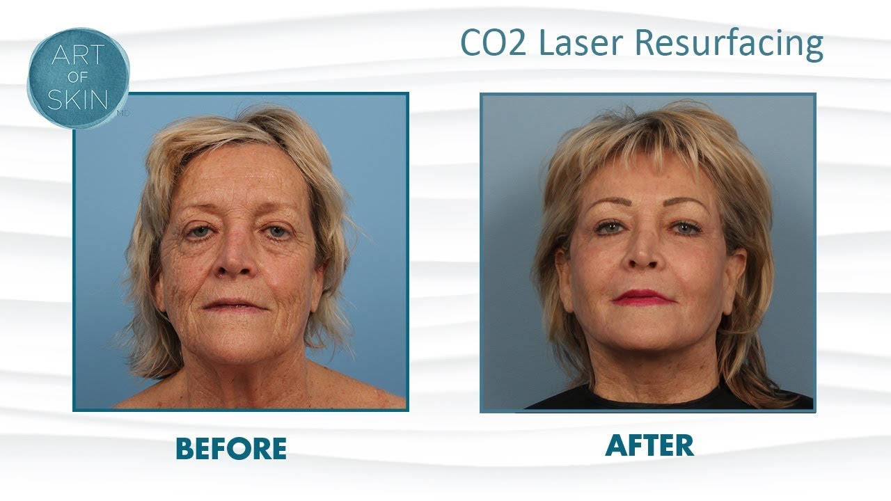 Laser resurfacing peel face and mouth YouTube