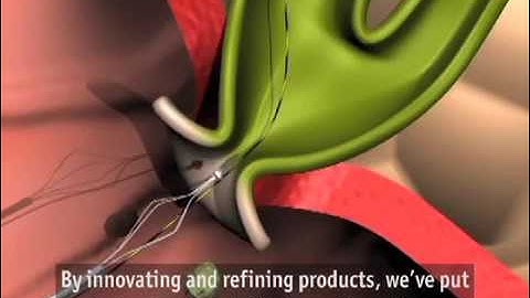 Trapezoid™ RX Retrieval Basket Animation