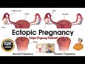 Ectopic Pregnancy | Medical Treatment | Avoid Surgery | Laparoscopic Surgery | Key Hole Surgery