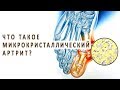 Что такое микрокристаллический артрит и как он лечится?