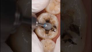 Deep Hole in Tooth Fixed! Extreme Cavity Removal &amp; Restoration 😱