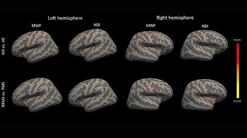 Myelin and axon pathology in MS assessed by myelin water and multi-shell diffusion imaging