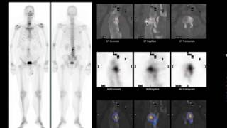 Whole Body Bone Scan Teaching File from Nuclear Medicine Handbook