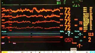 Waking up from anesthesia - EEG deep sedation_no sound