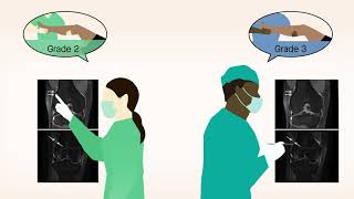 Kaplan Fiber Injury Not Correlated With High Grade Pivot Shift In Acl Injury