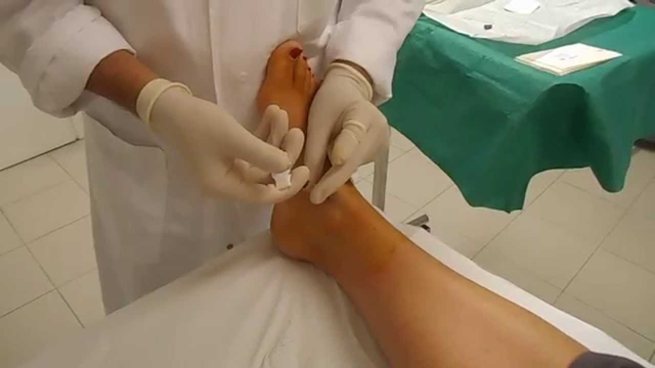 Operazione Caviglia Tempi Di Recupero infiltrazione caviglia - YouTube