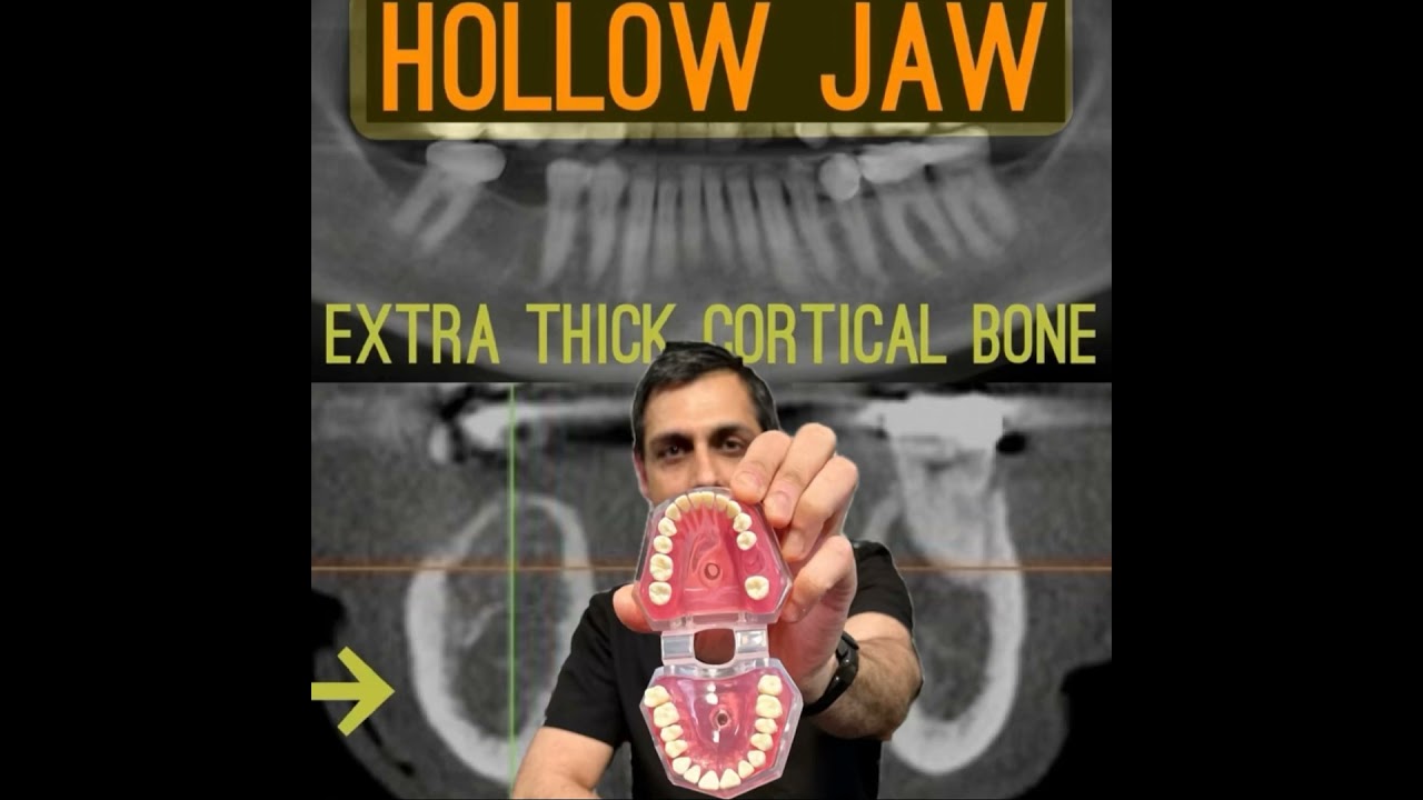 ep 002: Hollow Jaw / Focal Osteoporotic Bone Marrow Defects and How They Affect Dental Implants