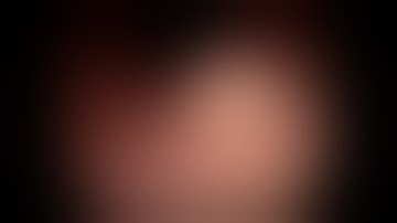 Endoscopic full thickness resection with closure of Gastric GIST